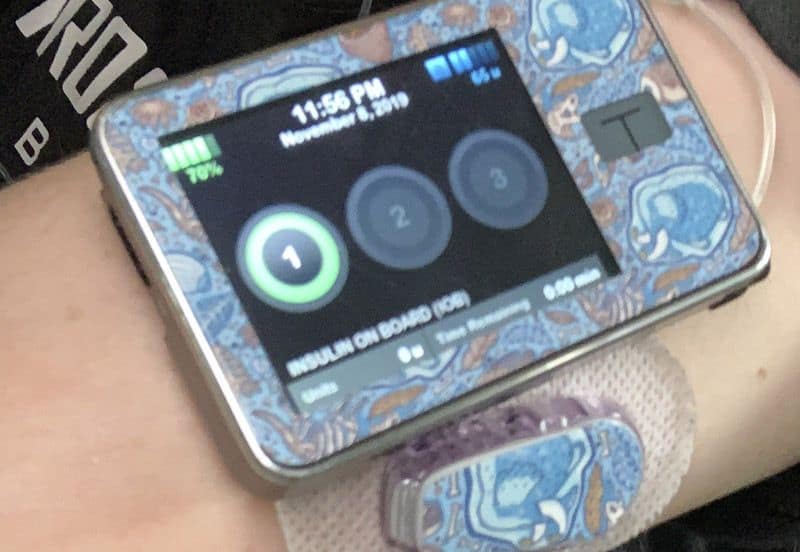 Pompe à insuline Haley Leshko T Slim + Dexcom CGM