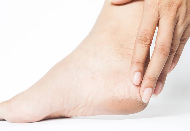 Early Stages Of Diabetic Foot Problems And Care