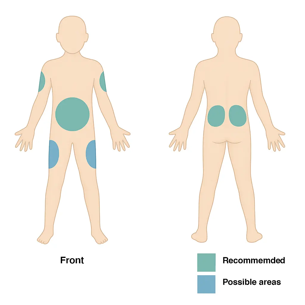 Insulin Injection Sites 1 A Diagram Showing The Front And Back Of A Body Displaying Recommended And Possible Areas For Injecting Insulin.