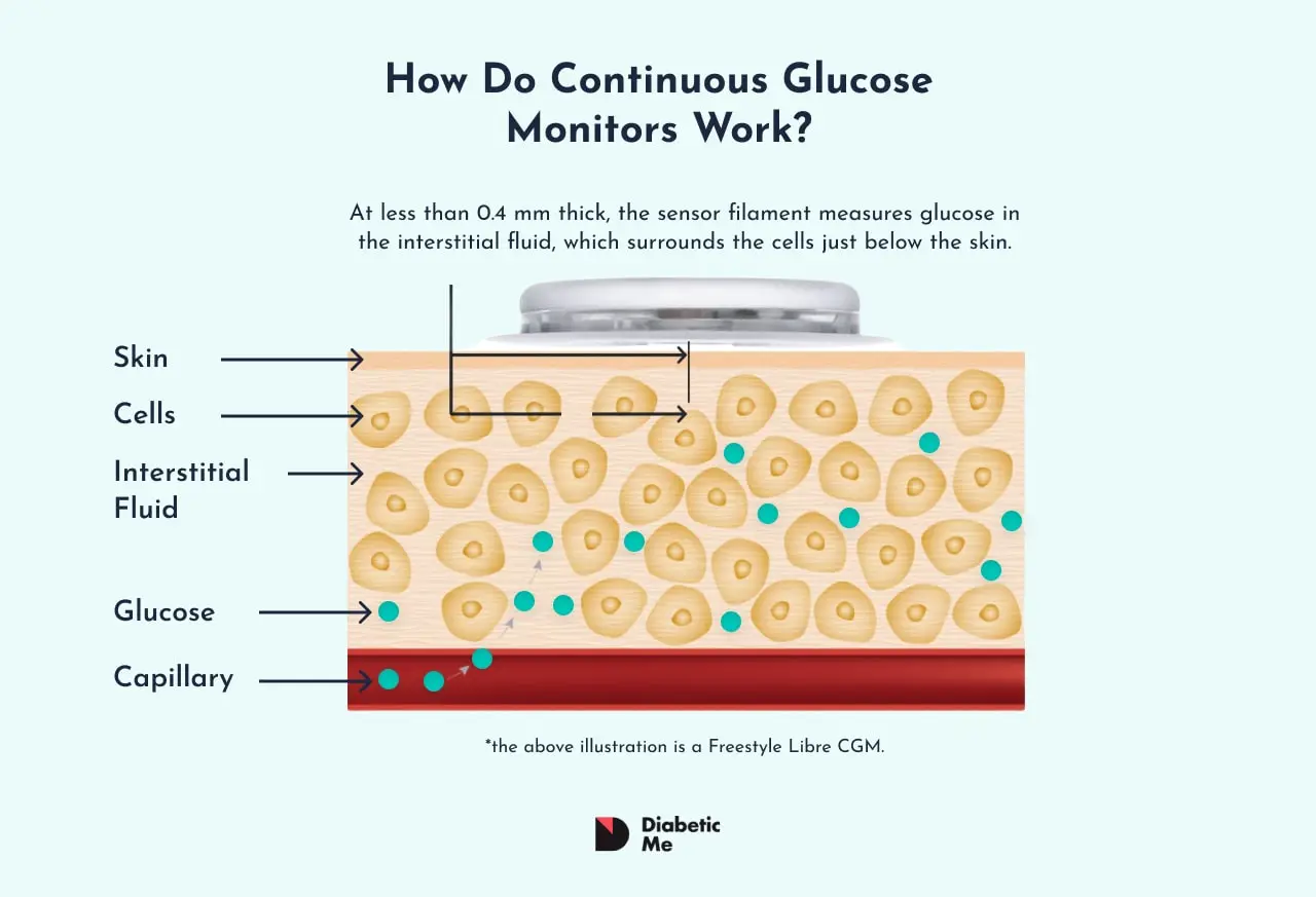 How Do Continuous Glucose Monitors Work